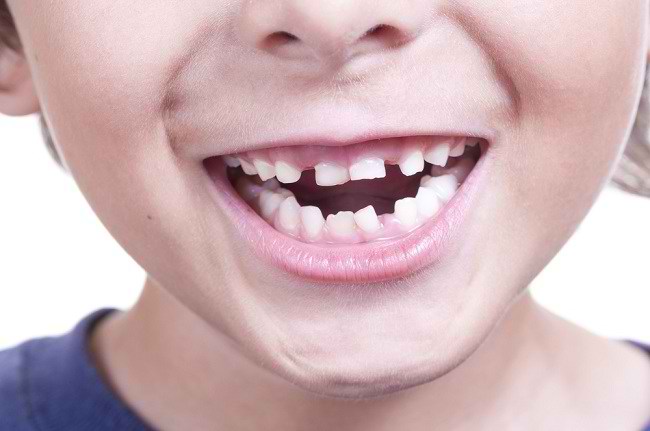Cara Mudah Menghindari Gigi Anak Dari Berlubang